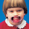 Spandex Lip & Cheek Retractor, Child