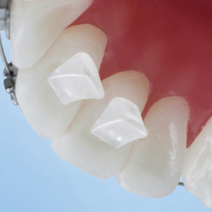 Bite-Builder Orthodontic Bite Opener
